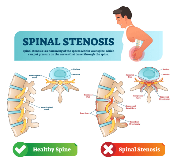 Condition - Stenosis