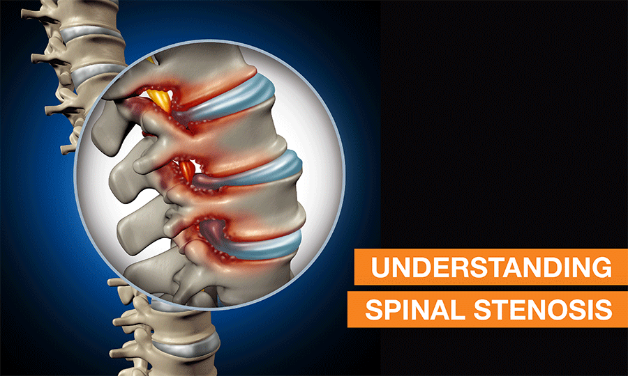 Blog Image - Understanding Spinal Stenosis