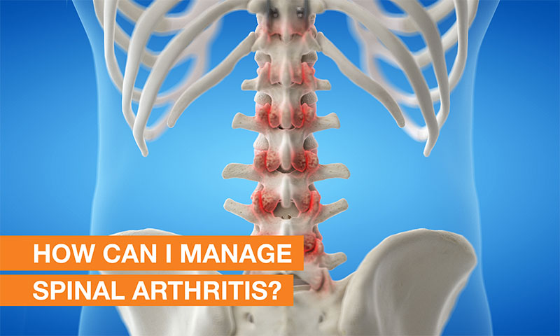 Blog Image - How can I manage spinal arthritis?