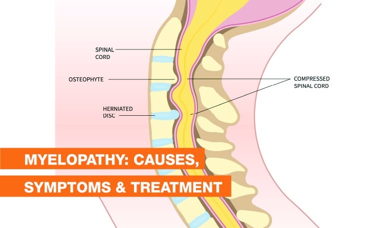 Blog Image - Myelopathy: Causes, Symptoms & Treatment