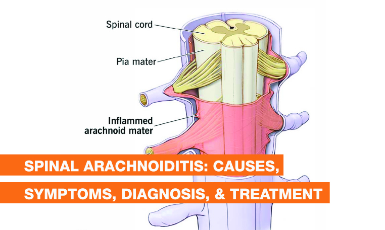 Blog Image - Spinal Arachnoiditis: Causes, Symptoms, Diagnosis, & Treatment