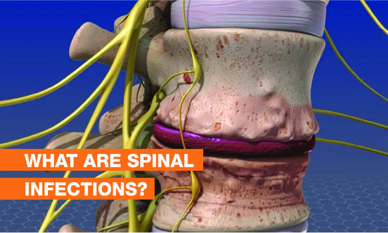 Blog Image - What are Spinal Infections?