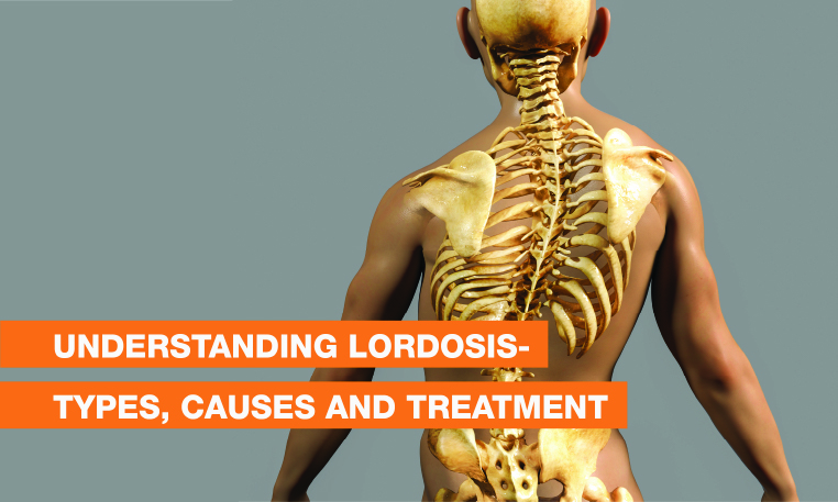 Blog Image - Understanding Lordosis- Types, Causes and Treatment