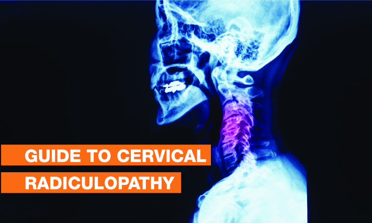 Blog Image - Guide to Cervical Radiculopathy